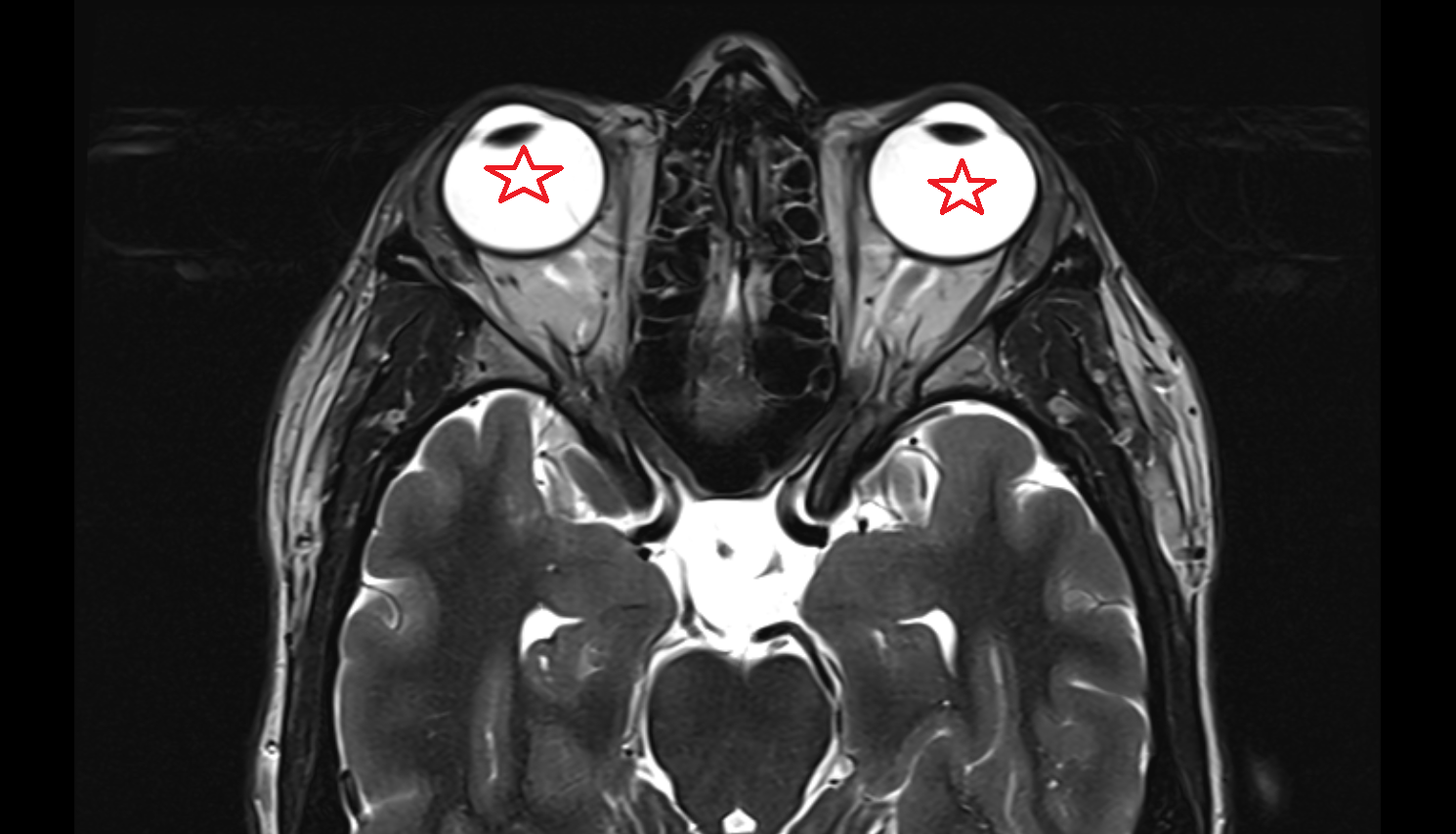 Eyeball  MRI axial  image-img-00000-00000