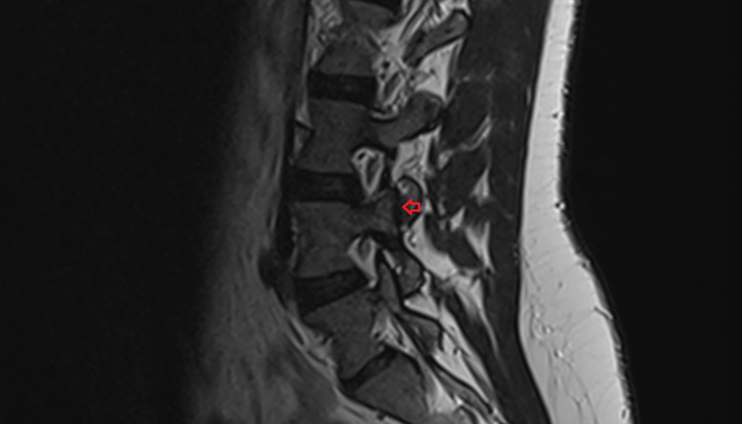 Facet joint of vertebra (Zygapophyseal joints)  mri sagittal  image -img-00000-00000