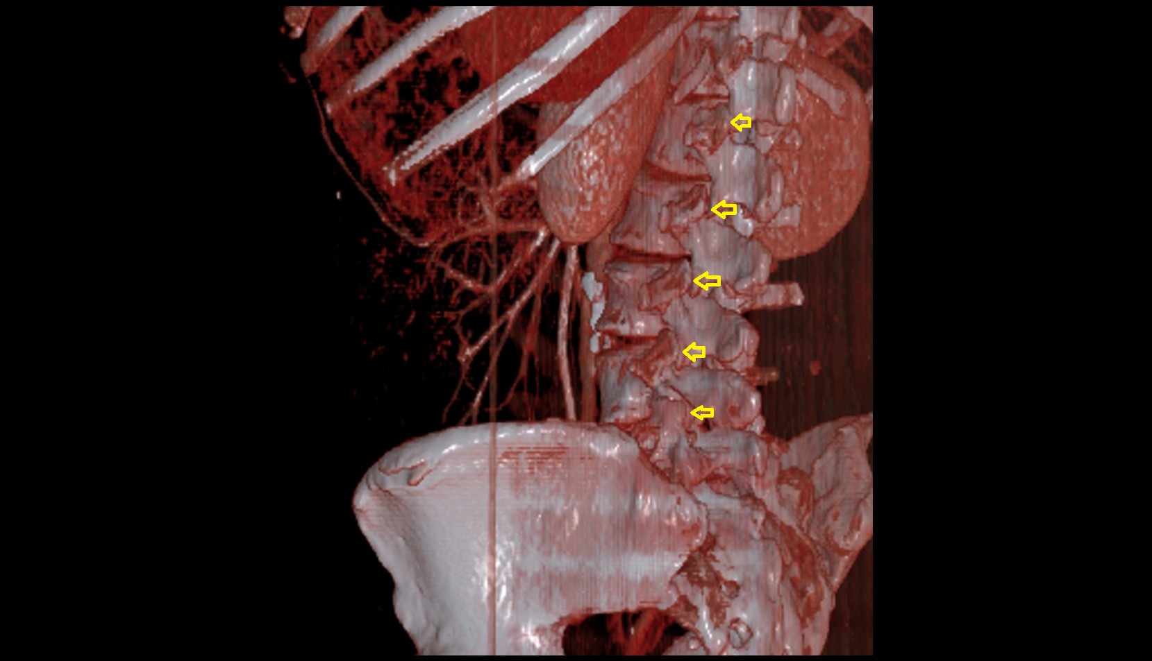 Facet joints  of vertebrae ct  3d image