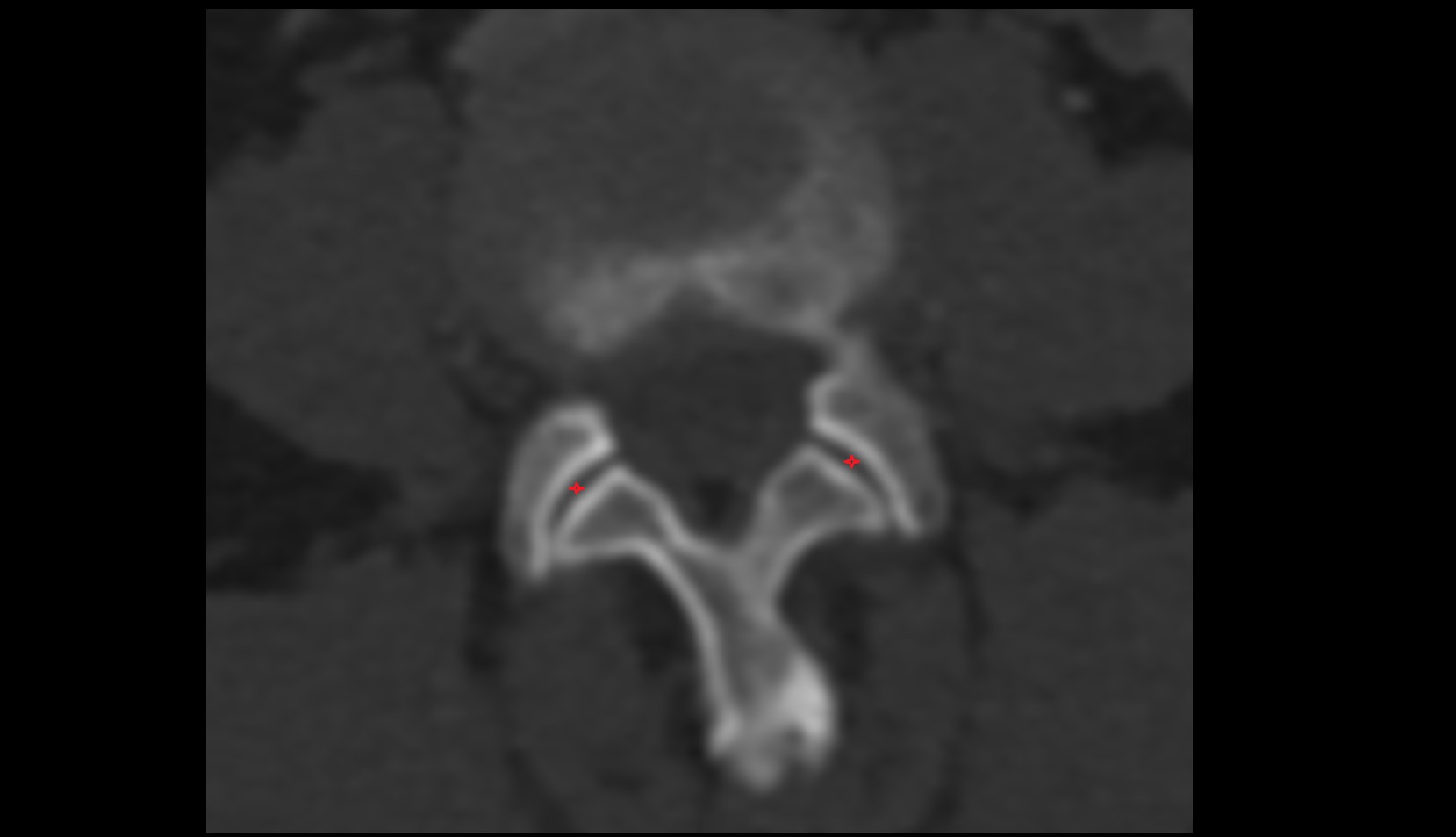 Facet joints  of vertebrae ct axial image