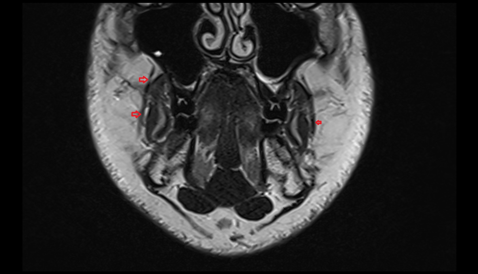 Facial Vein coronal mri image