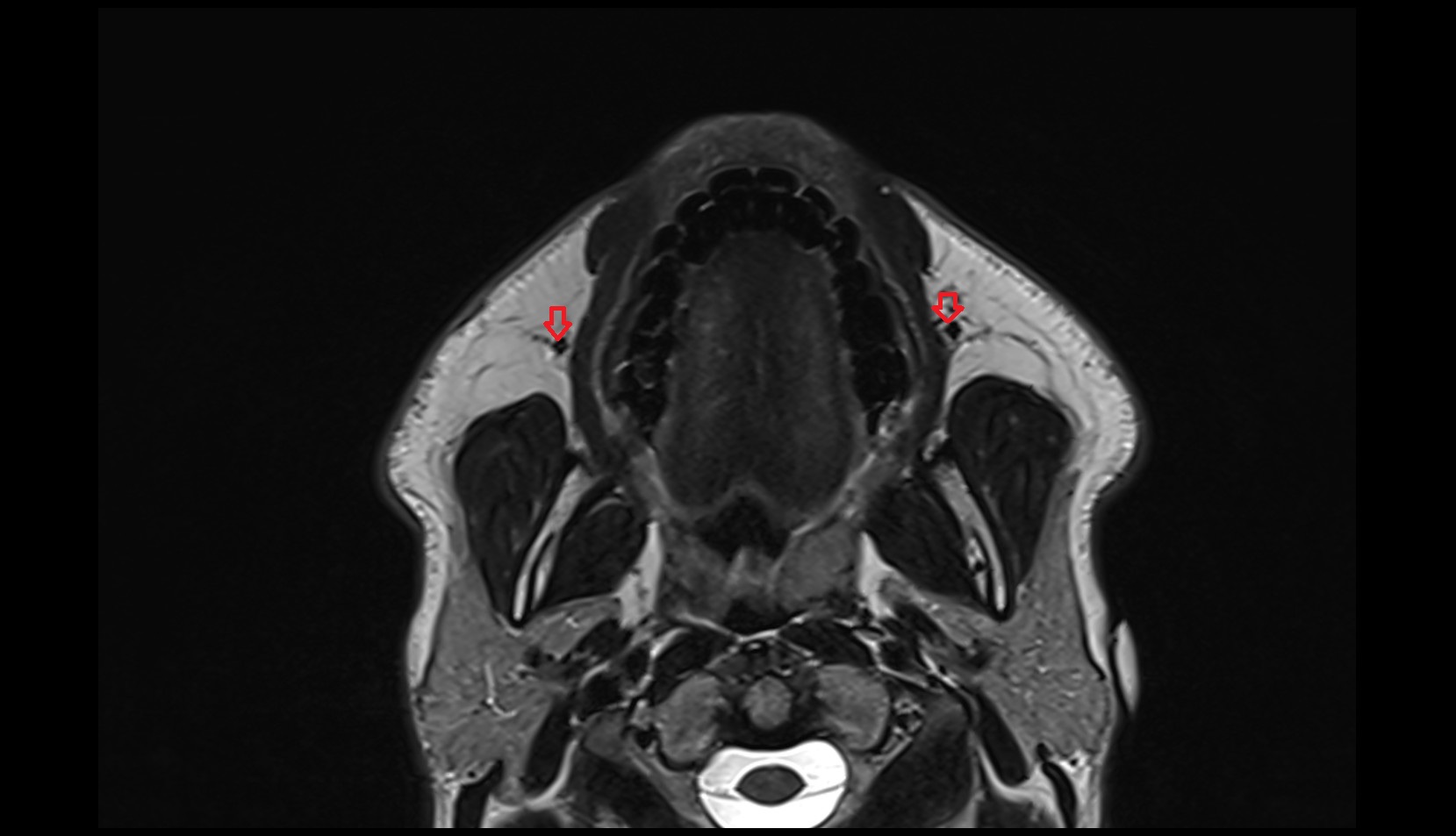 Facial Vein mri axial image