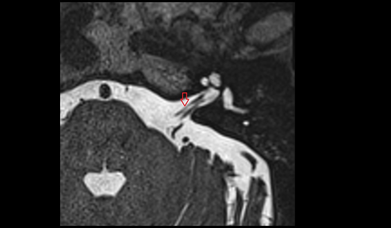 Facial nerve (Cranial nerve VII) MRI 3T axial image