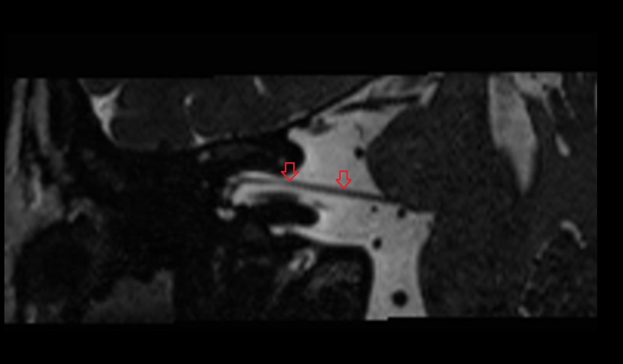 Facial nerve (Cranial nerve VII) MRI 3T coronal image