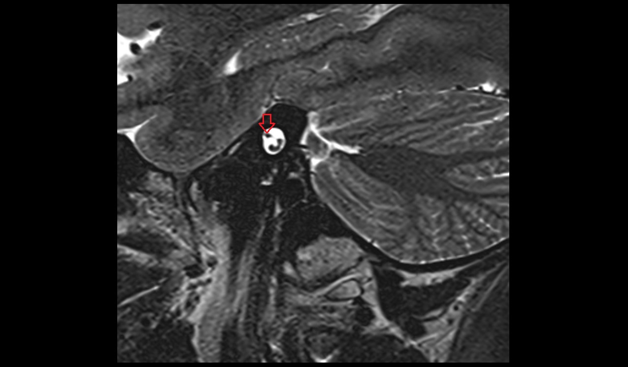 Facial nerve (Cranial nerve VII) MRI 3T sagittal image 1