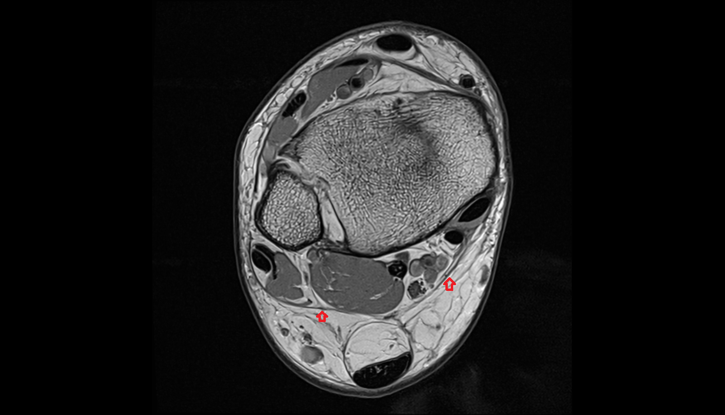 Fascia cruris axial  cross sectional anatomy 3T MRI AI enhanced radiology image-img-00000-00000