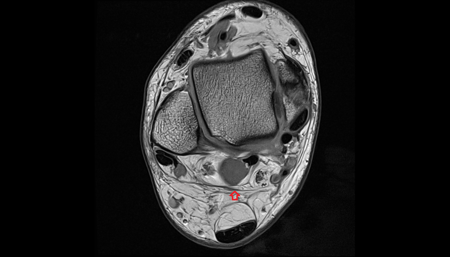 Fascia cruris axial  cross sectional anatomy 3T MRI AI enhanced radiology image-img-00000-00000_00001
