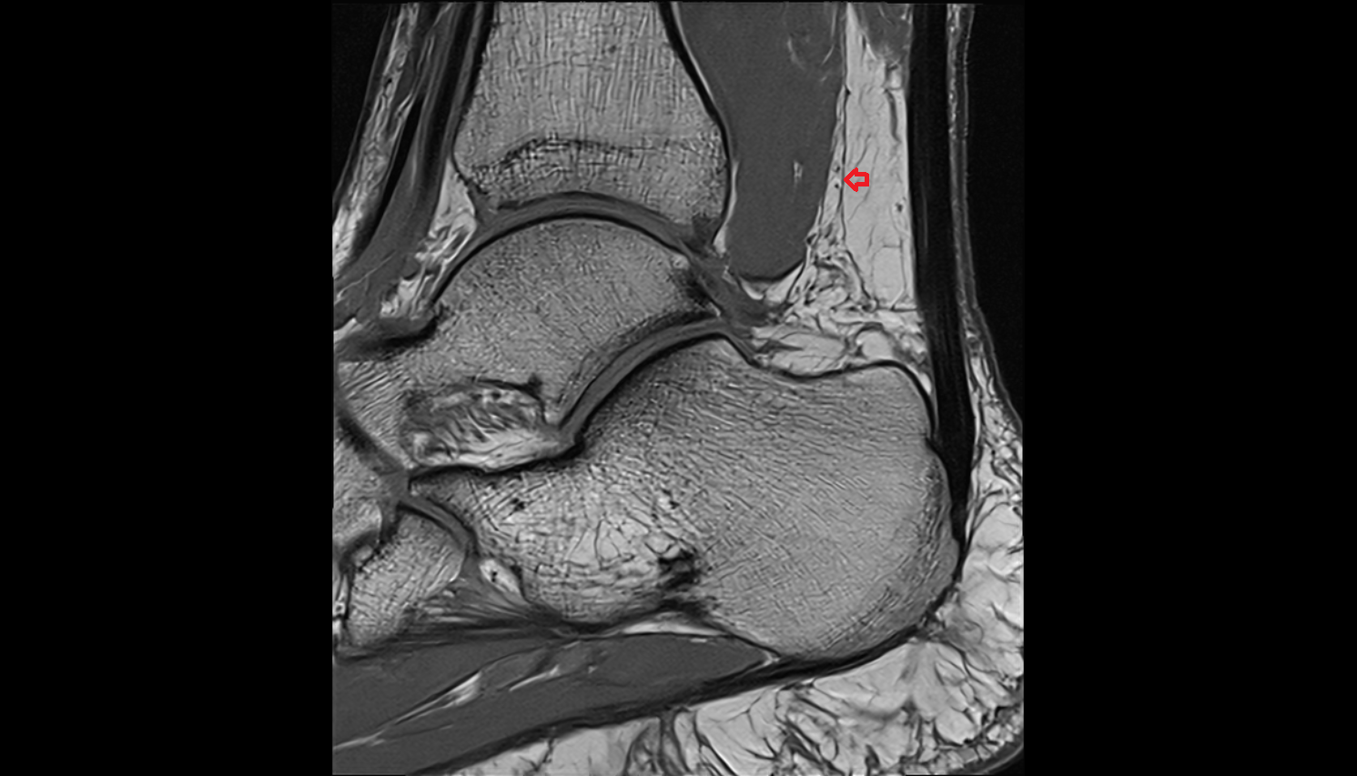 Fascia cruris axial  cross sectional anatomy 3T MRI AI enhanced radiology image-img-00000-00000_00002