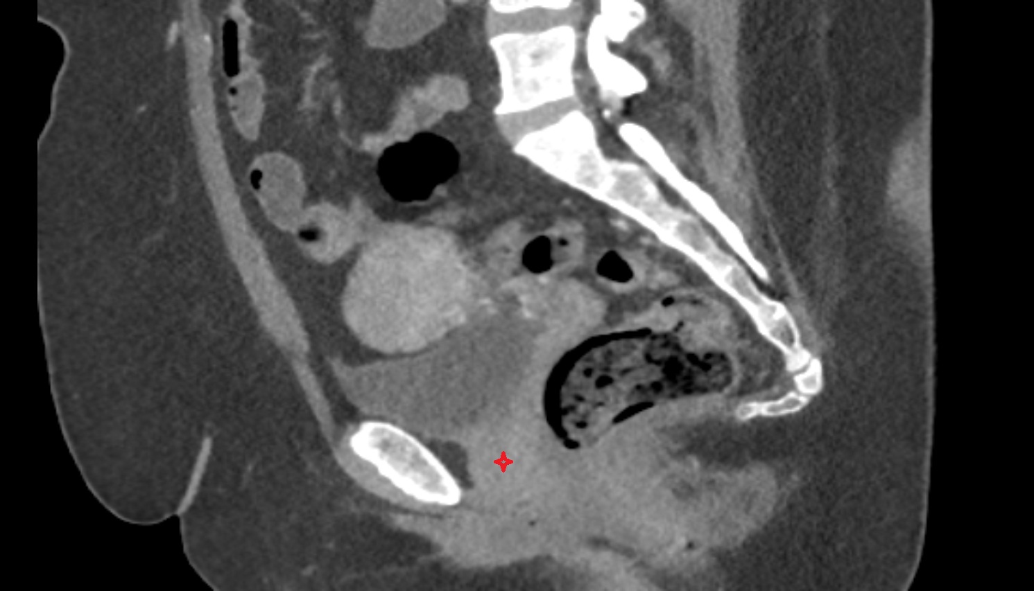 Female urethra  CT SAG  anatomy  image-img-00000-00000