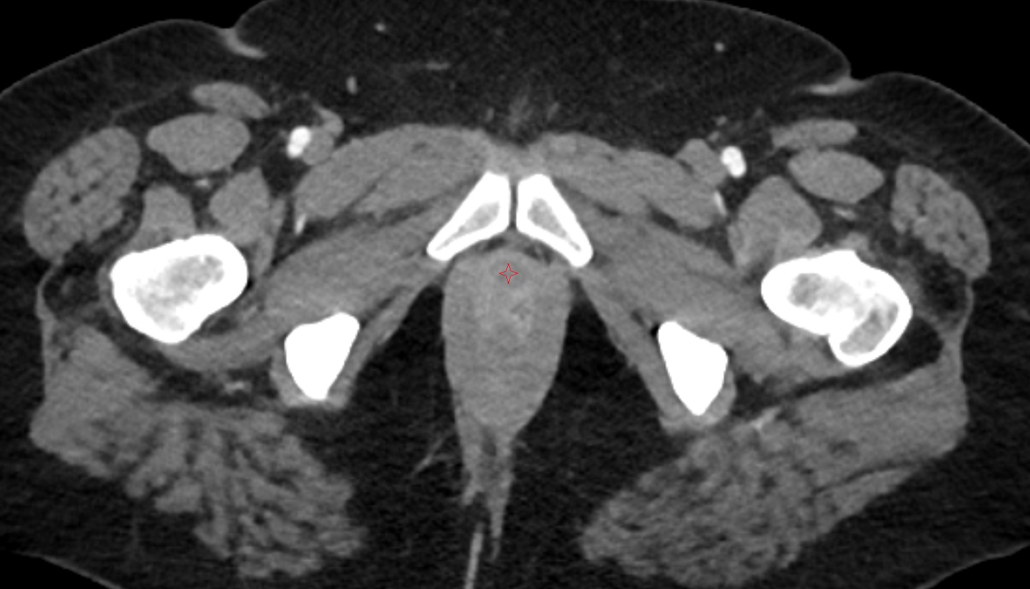 Female urethra  CT axial  anatomy  image-img-00000-00000