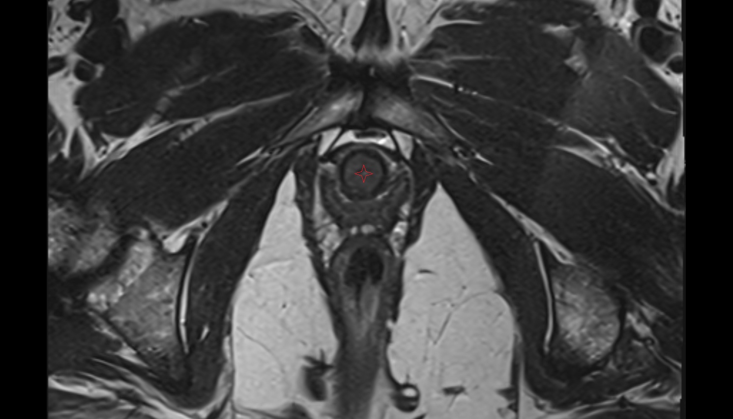 Female urethra  MRI axial  anatomy  image-img-00000-00000