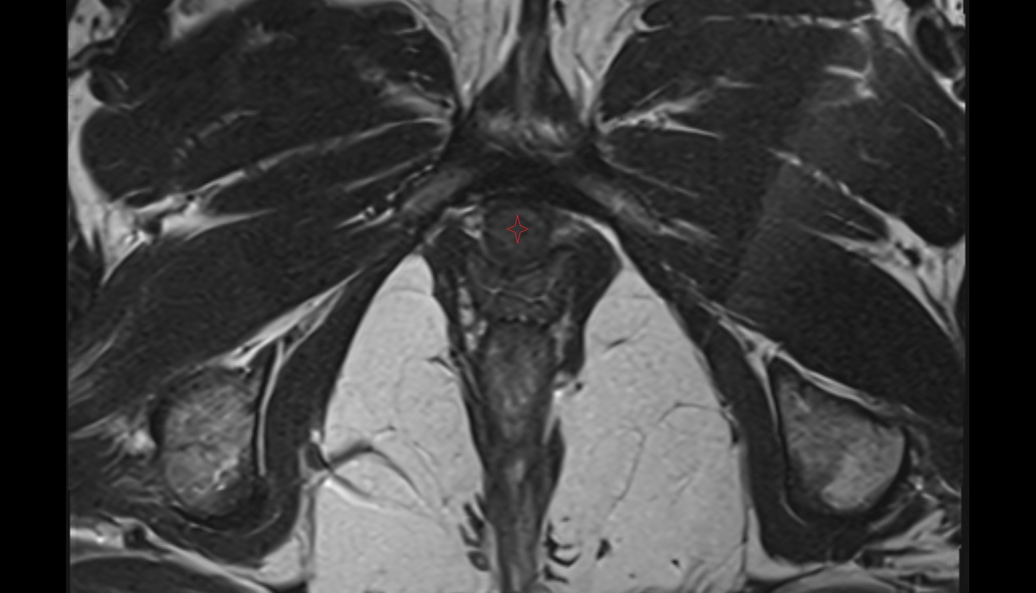 Female urethra  MRI axial  anatomy  image-img-00000-00000_00001