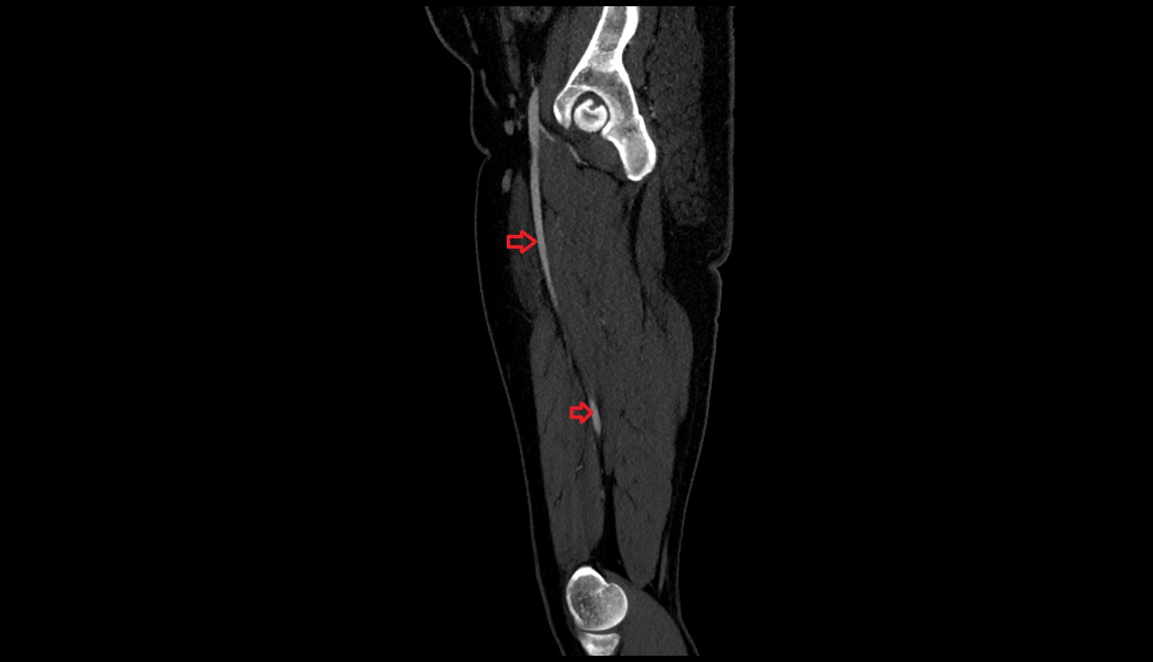 Femoral artery CT SAGITTAL IMAGE
