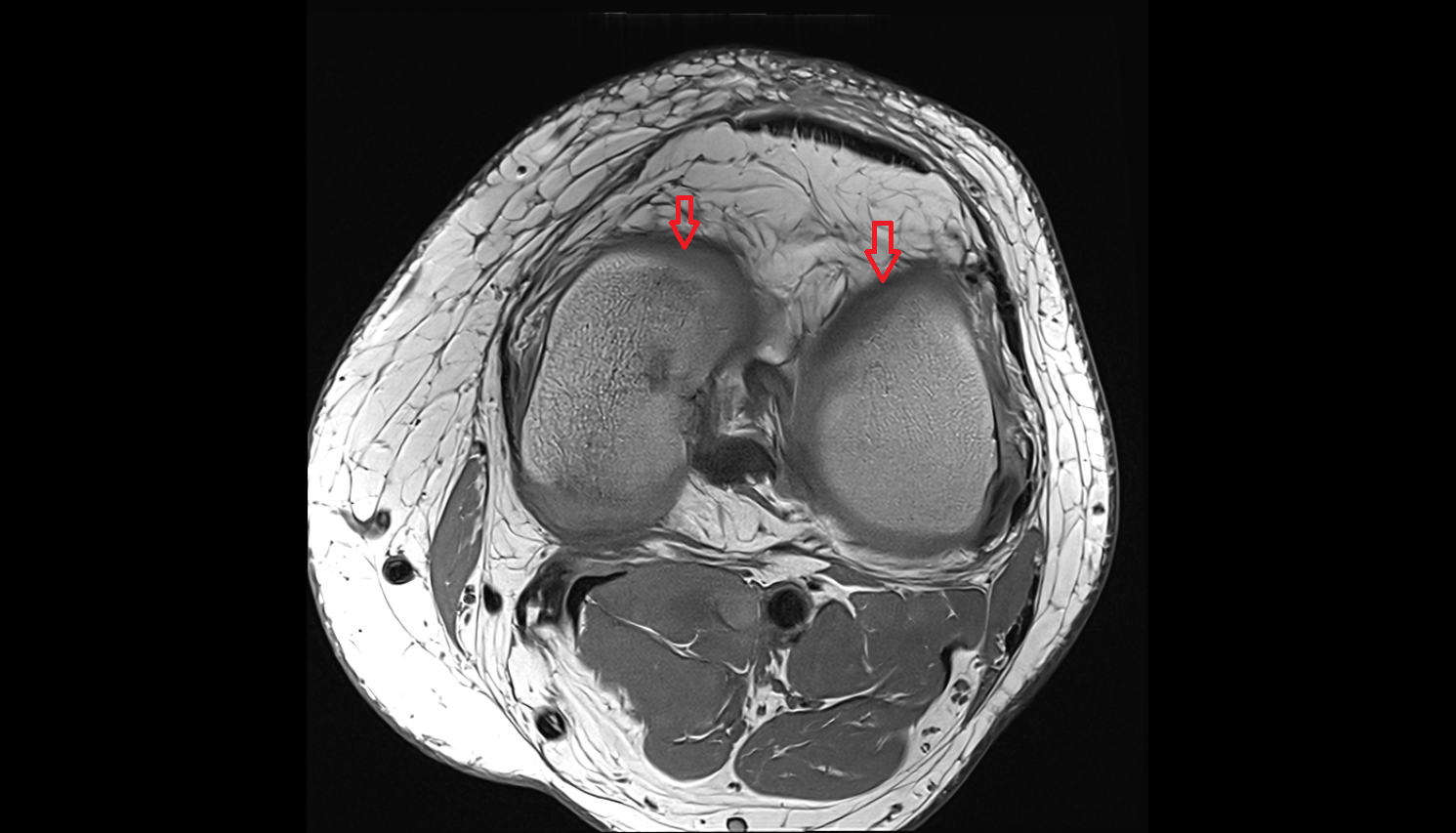 Femoral condyle articular cartilage axial cross sectional anatomy 3T MRI AI enhanced  radiology  anatomy image-img-00000-00000
