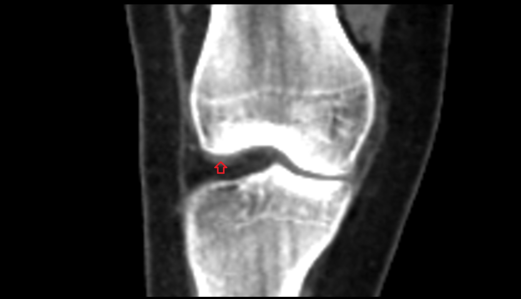 Femoral condyle articular cartilage ct image