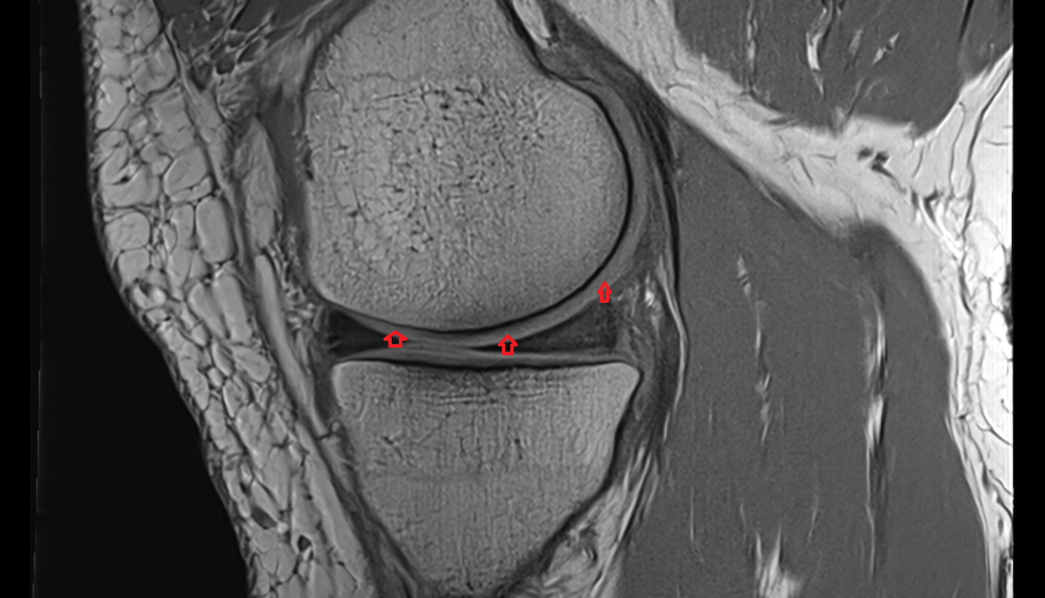 Femoral condyle articular cartilage sagittal cross sectional anatomy 3T MRI AI enhanced  radiology  anatomy image-img-00000-00000