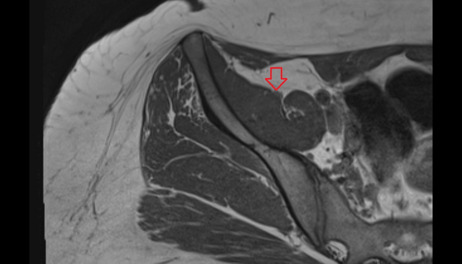 Femoral nerve  MRI axial  anatomy  image-img-00000-00000