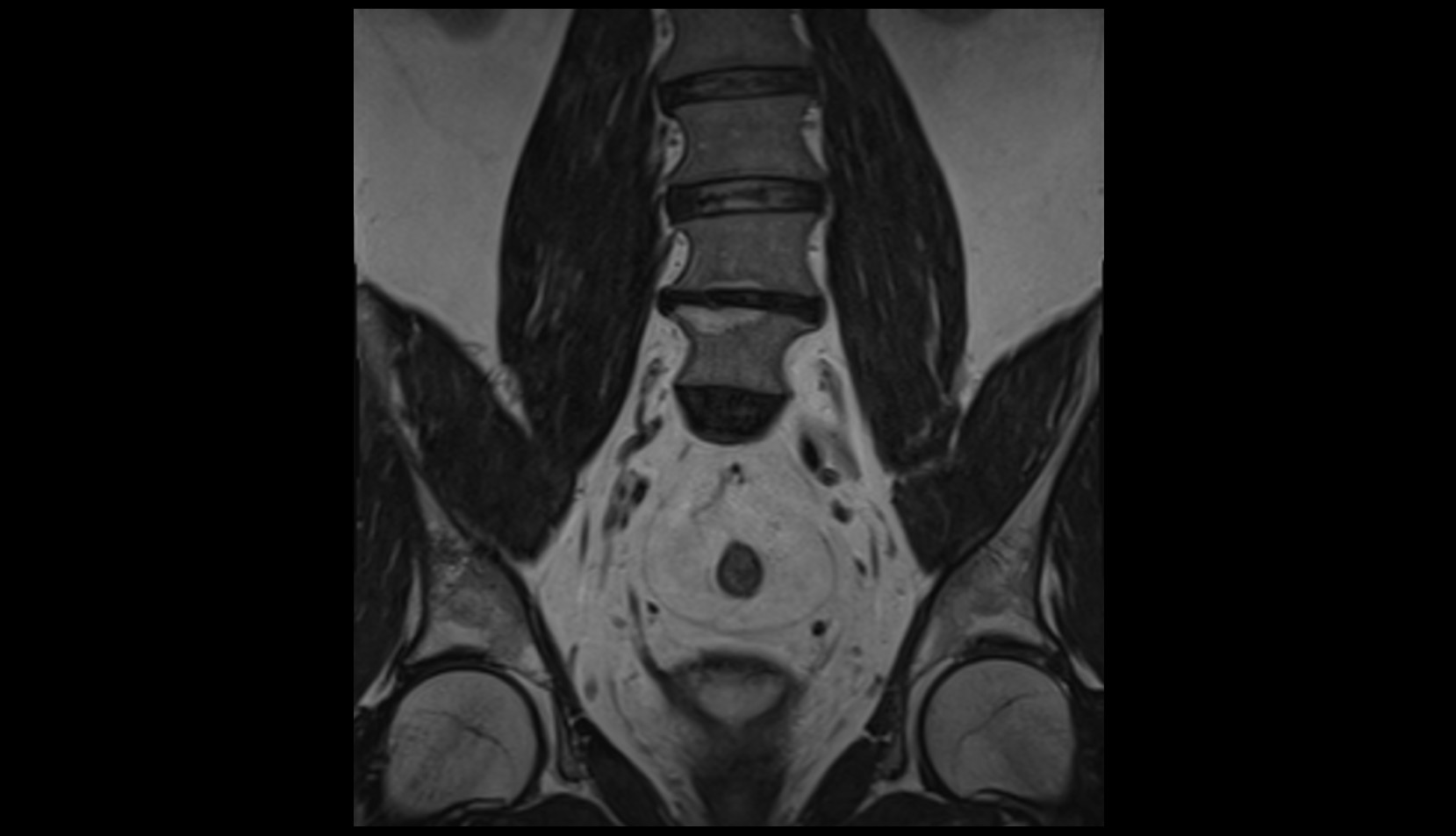 Femoral nerve mri coronal image