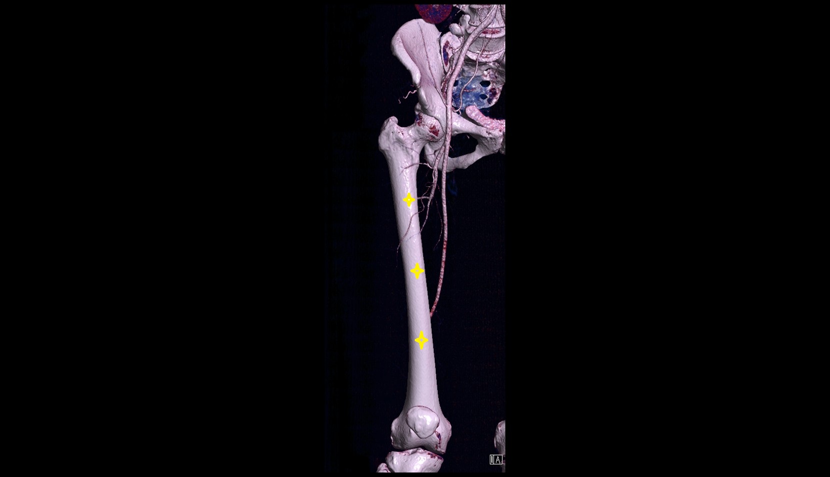 Femoral shaft 3D CT VRT image