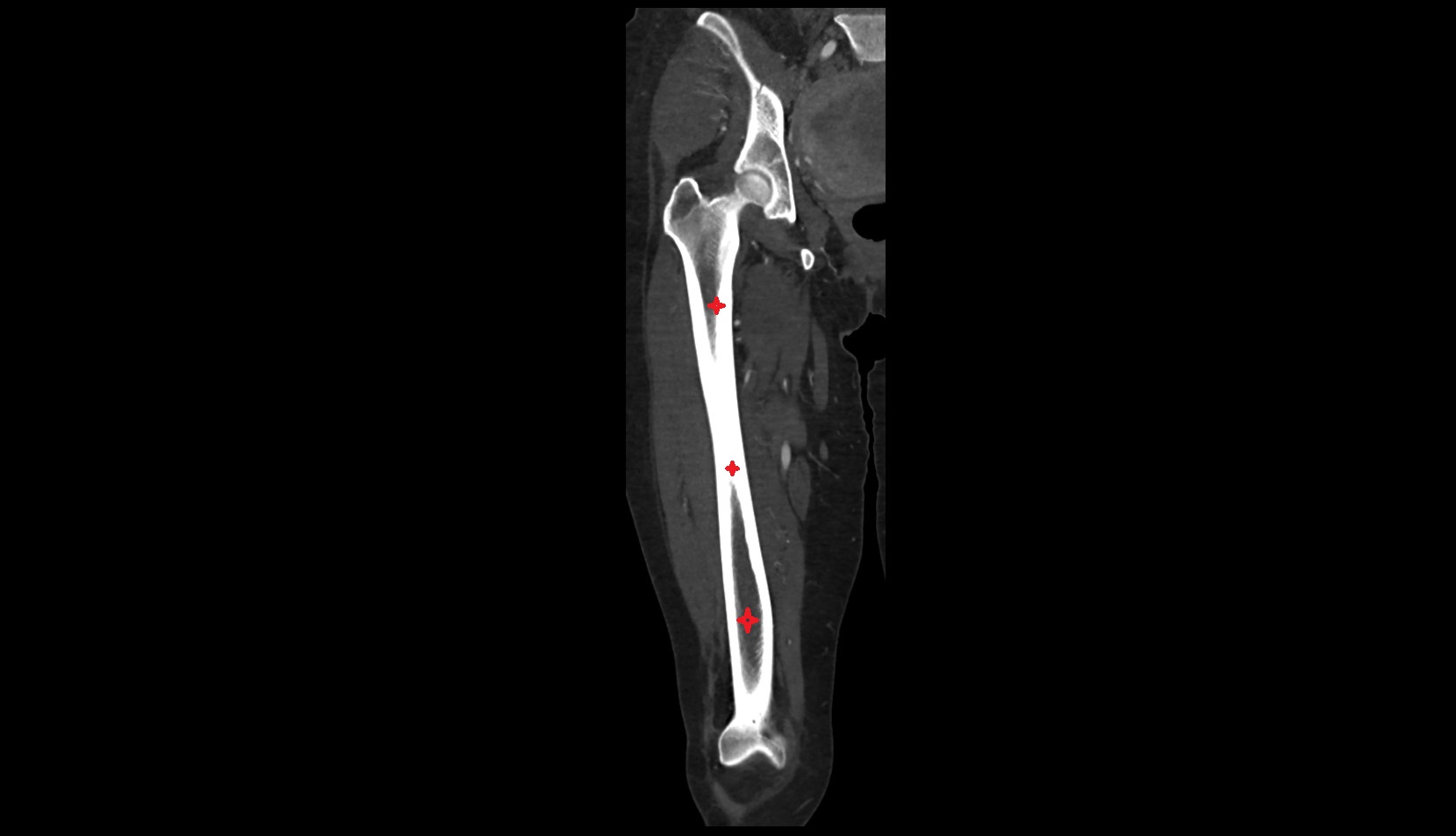 Femoral shaft CT CORONAL IMAGE
