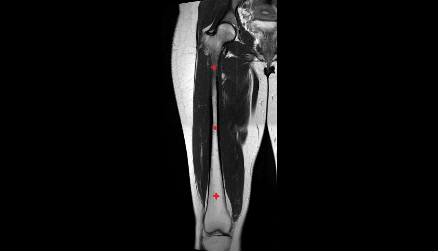 Femoral shaft  MRI CORONAL   anatomy image-img-00000-00000
