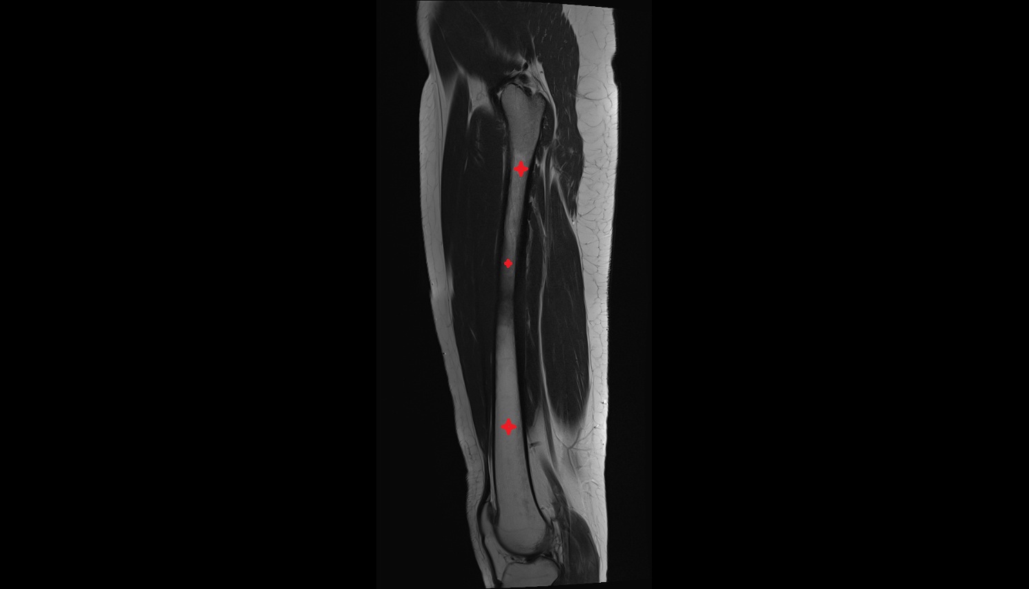Femoral shaft  MRI SAG   anatomy image-img-00000-00000