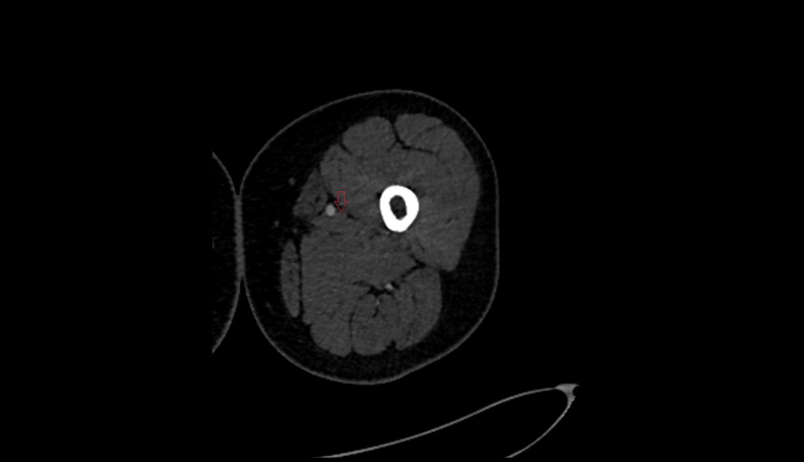 Femoral vein CT AXIAL IMAGE  1
