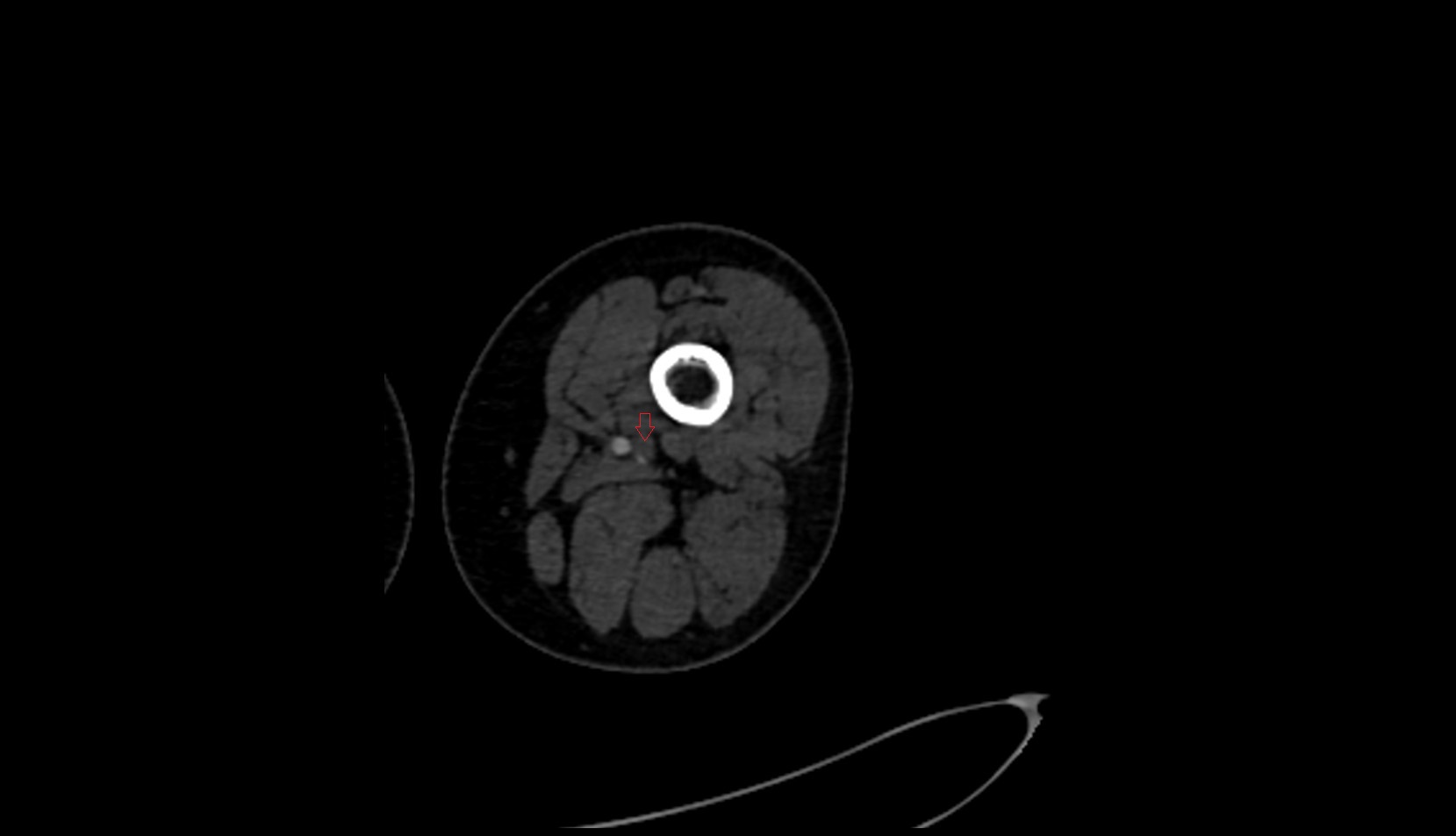 Femoral vein CT AXIAL IMAGE  2