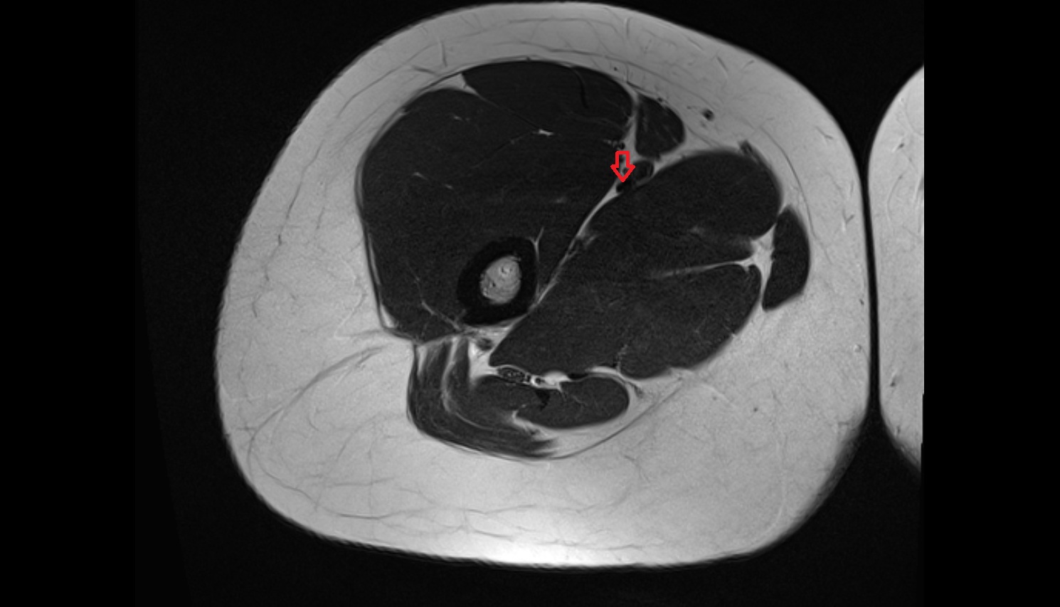 Femoral vein  MRI AXIAL anatomy image-img-00000-00000