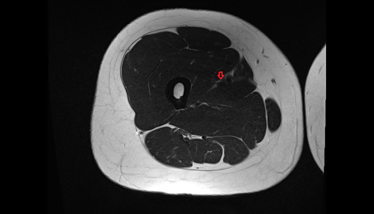 Femoral vein  MRI AXIAL anatomy image-img-00000-00000_00001
