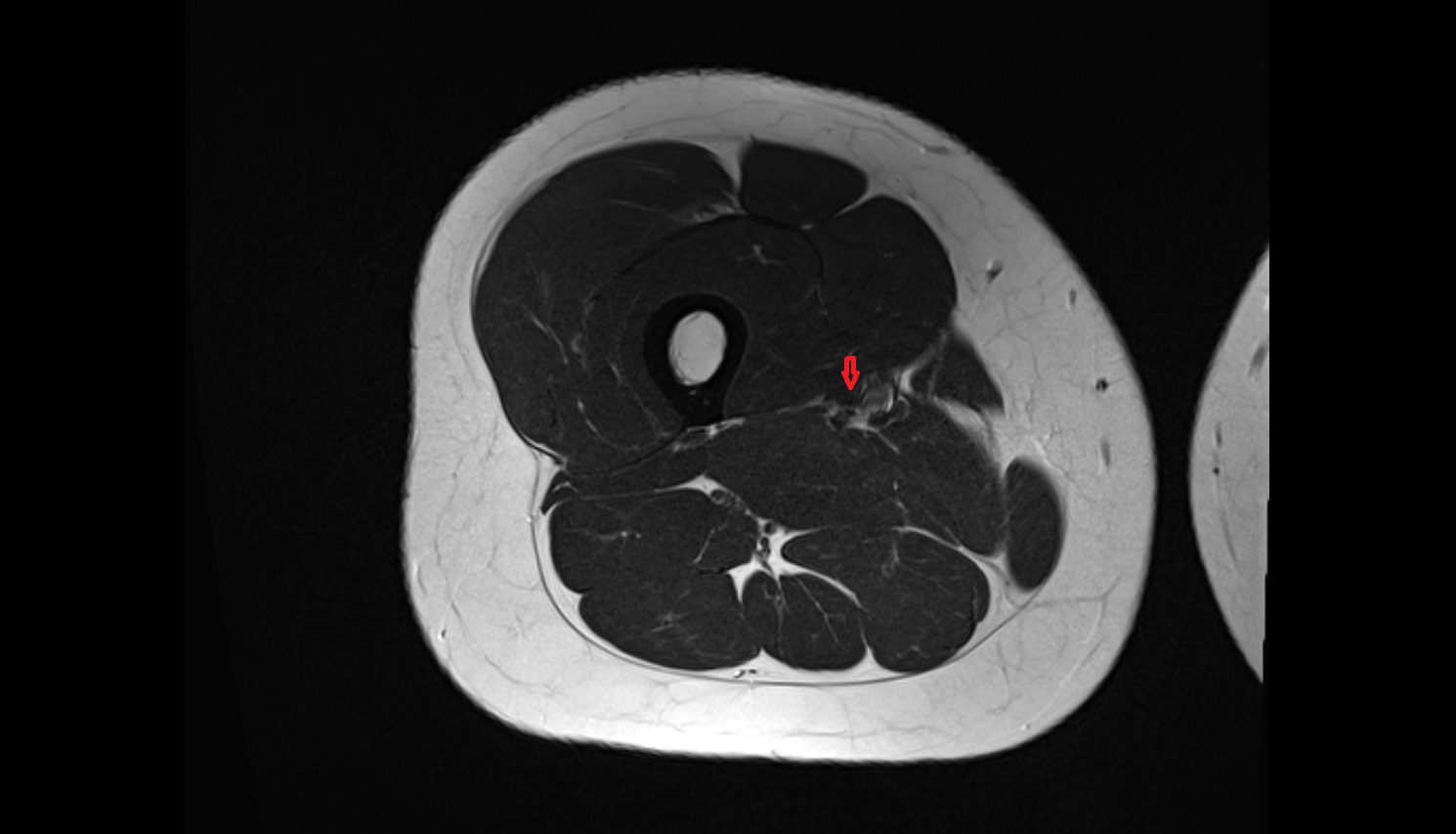 Femoral vein  MRI AXIAL anatomy image-img-00000-00000_00002
