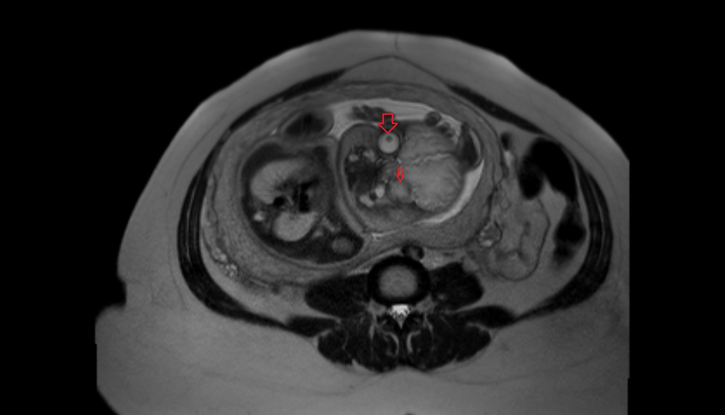 Fetal Eyes   MRI coronal  anatomy image-img-00000-00000