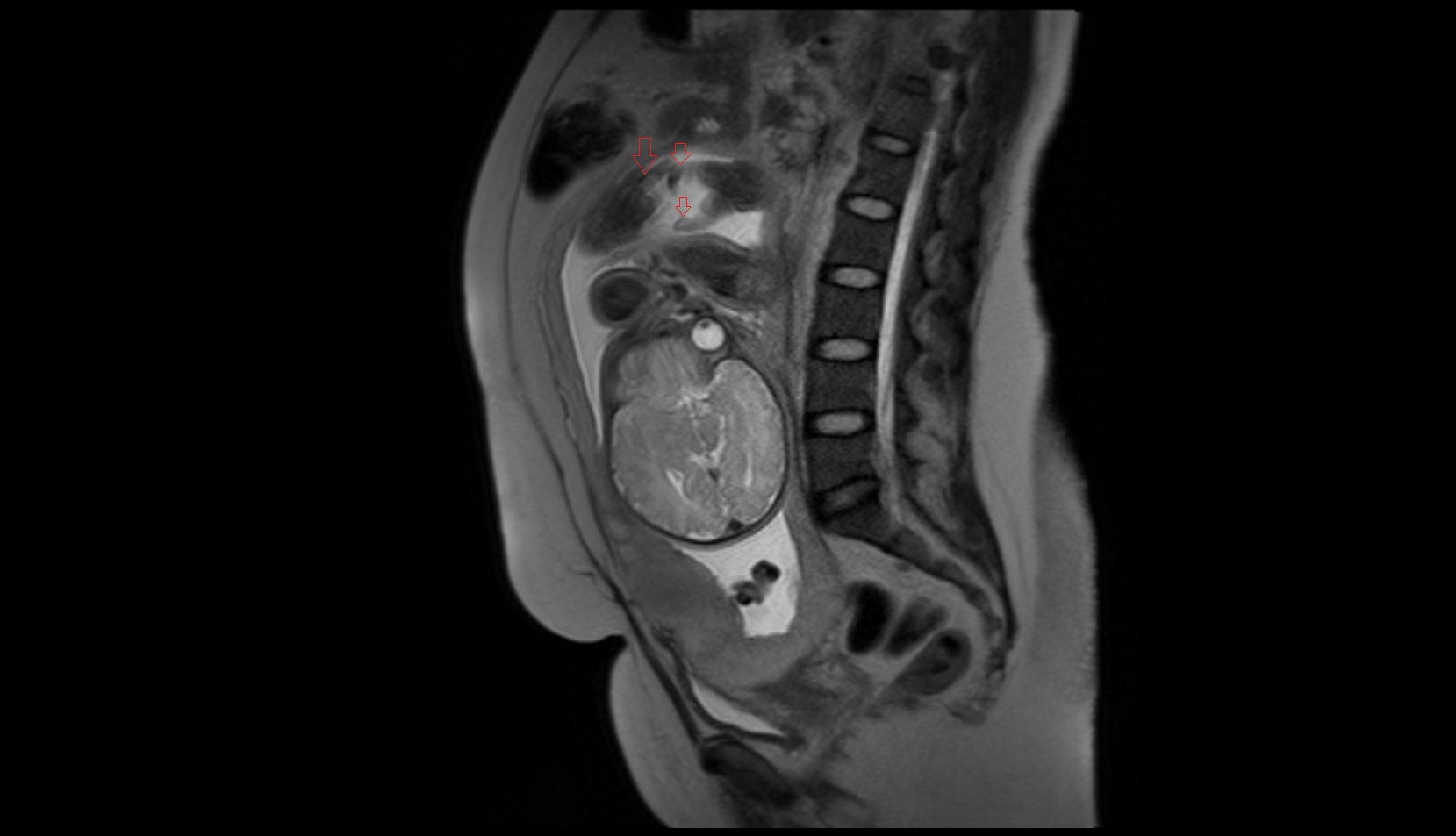 Fetal Fingers mri axial image