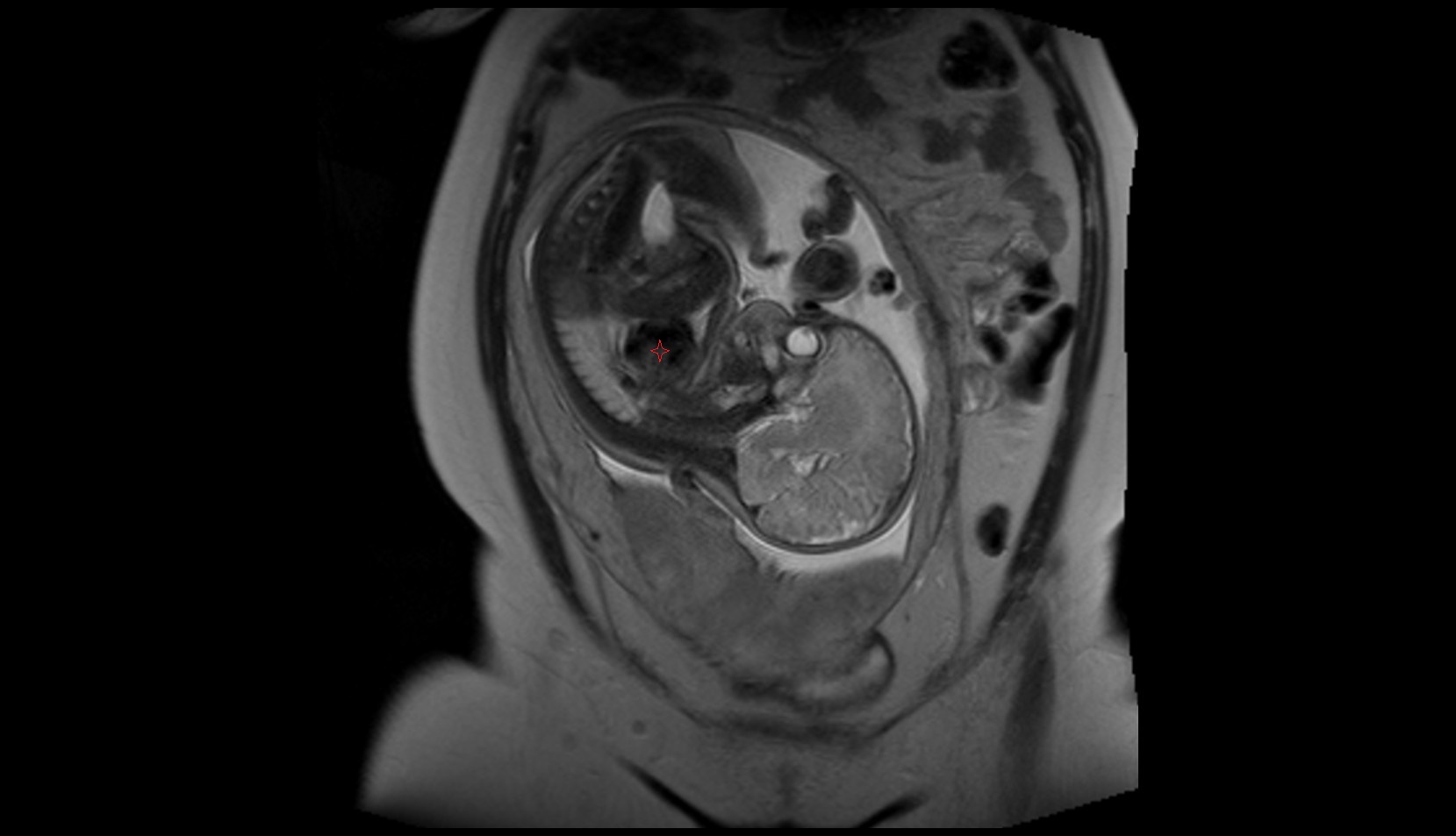 Fetal Heart mri sag