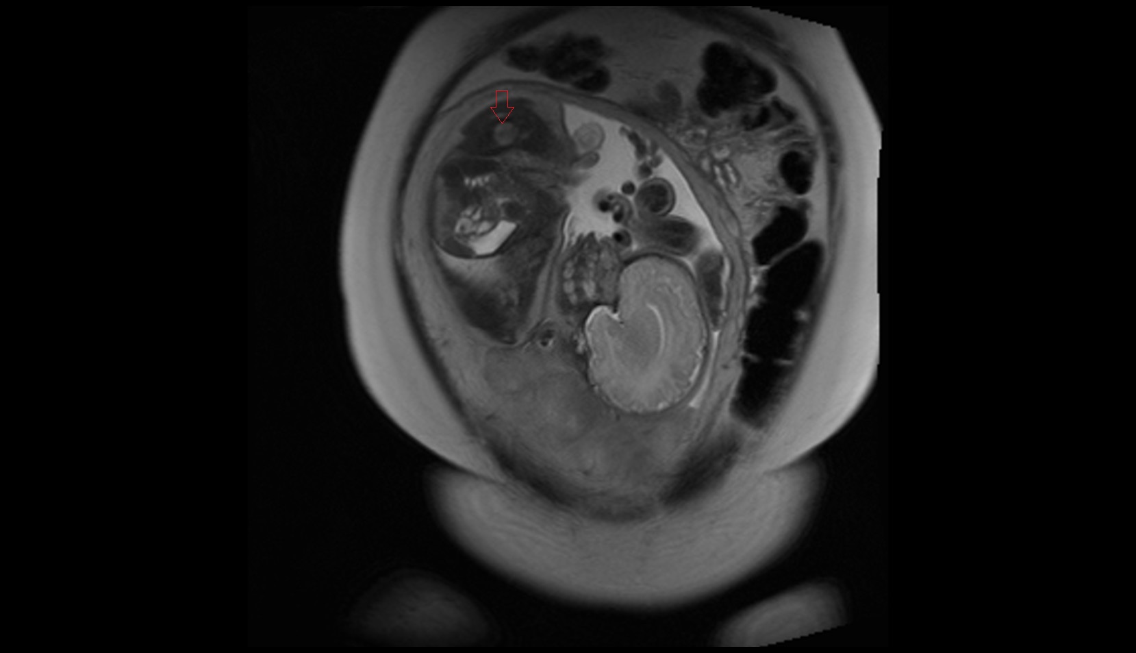 Fetal Hip mri coronal image
