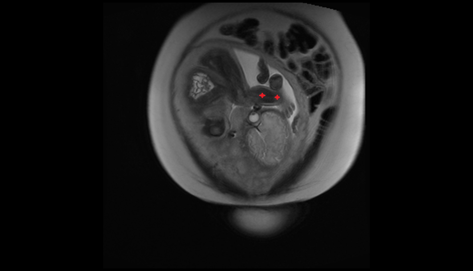 Fetal Lower Leg mri coronal image