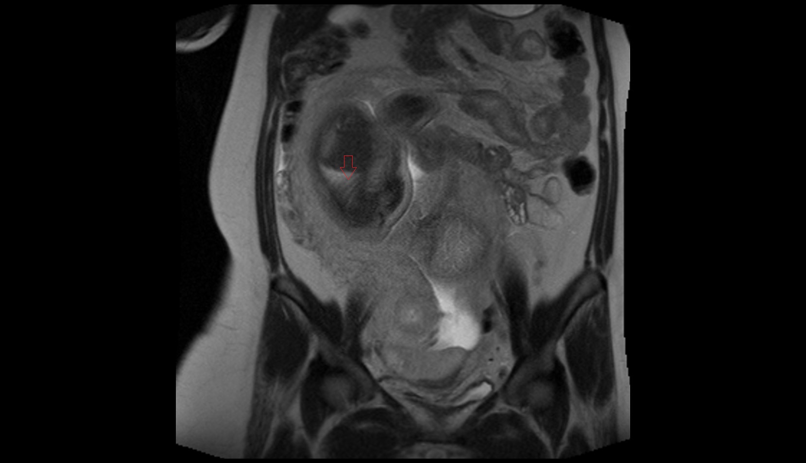 Fetal Ribs mri image