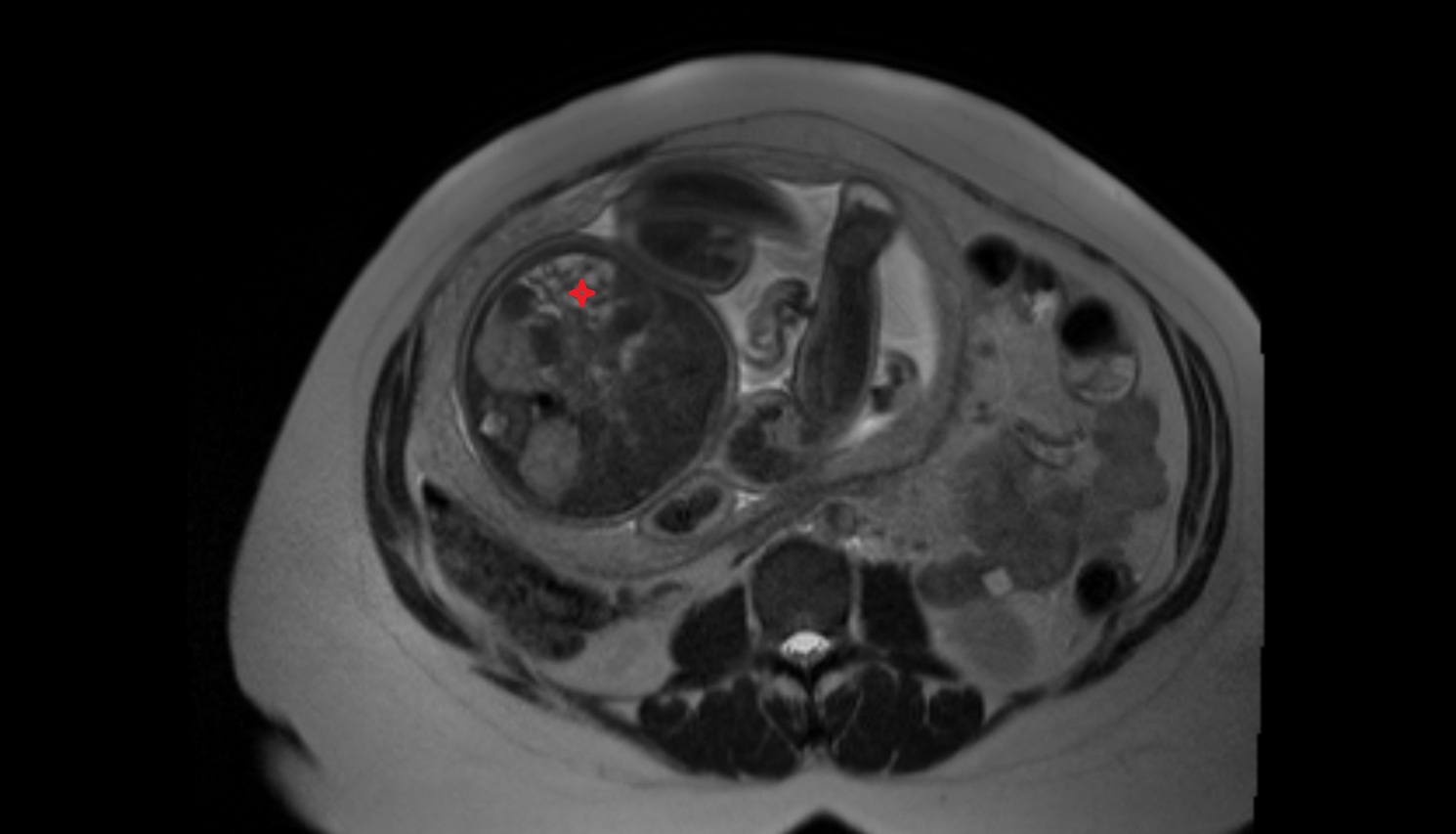 Fetal Small bowel  MRI axial  anatomy image-img-00000-00000
