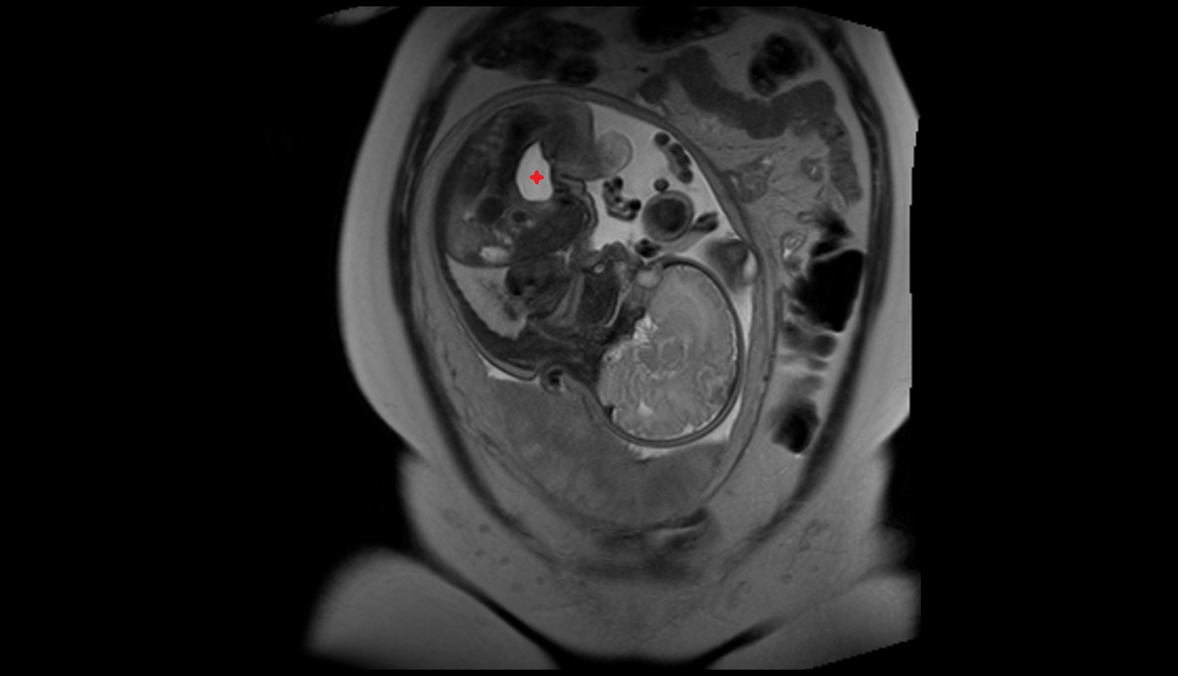 Fetal Urinary Bladde mri sag image