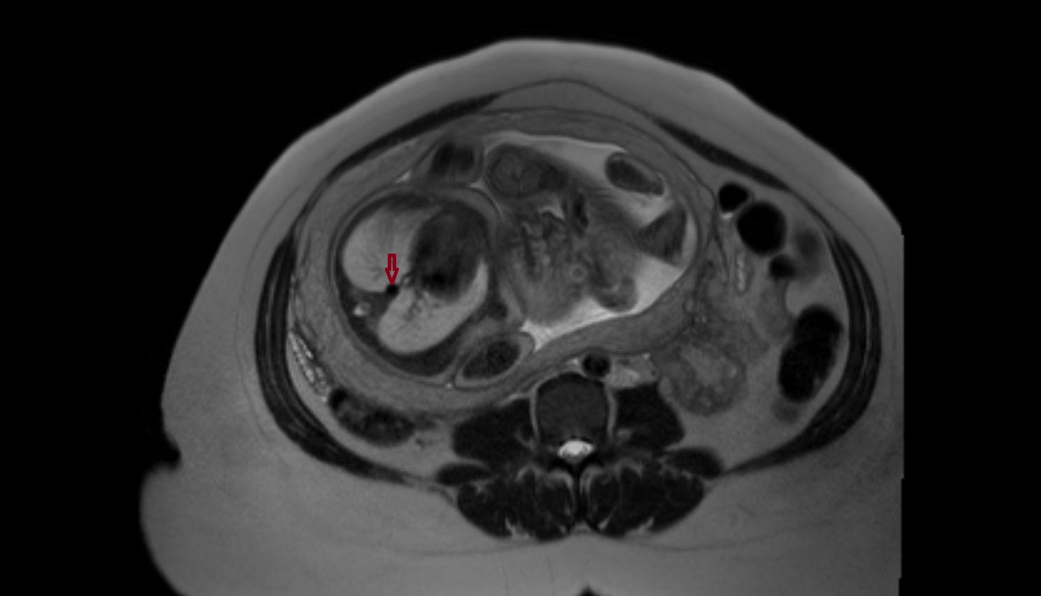 Fetal aorta  MRI axial  anatomy image-img-00000-00000
