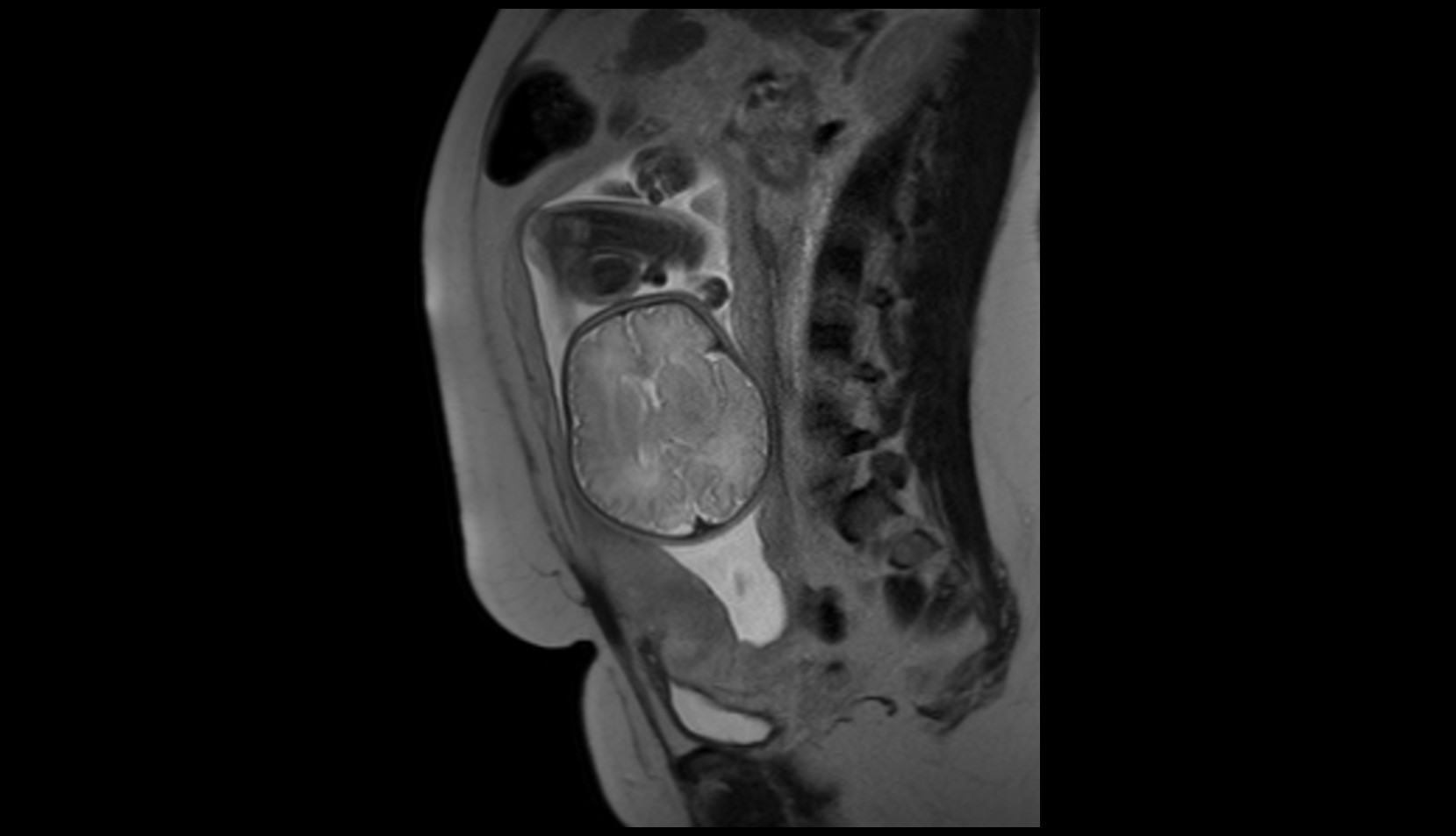 Fetal brain MRI axial image
