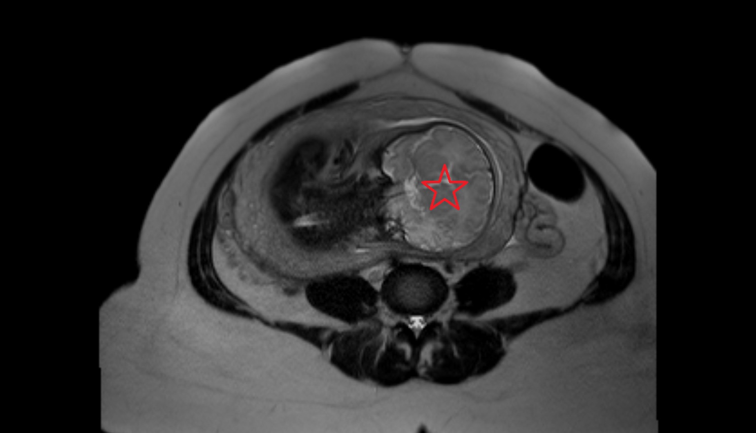 Fetal brain   MRI coronal  anatomy image-img-00000-00000