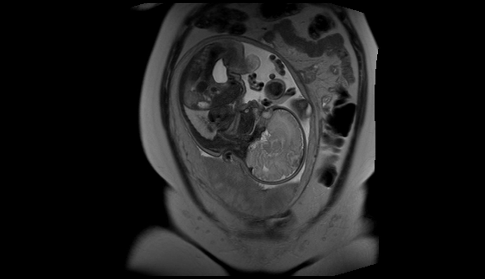 Fetal brain mri sag image