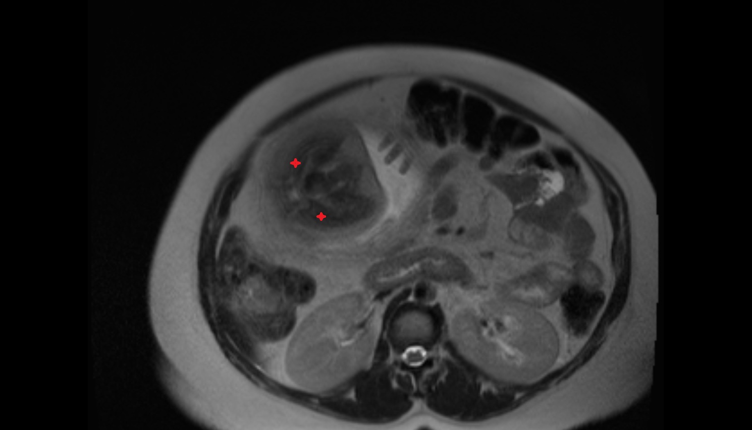 Fetal buttock  MRI axial  anatomy image-img-00000-00000