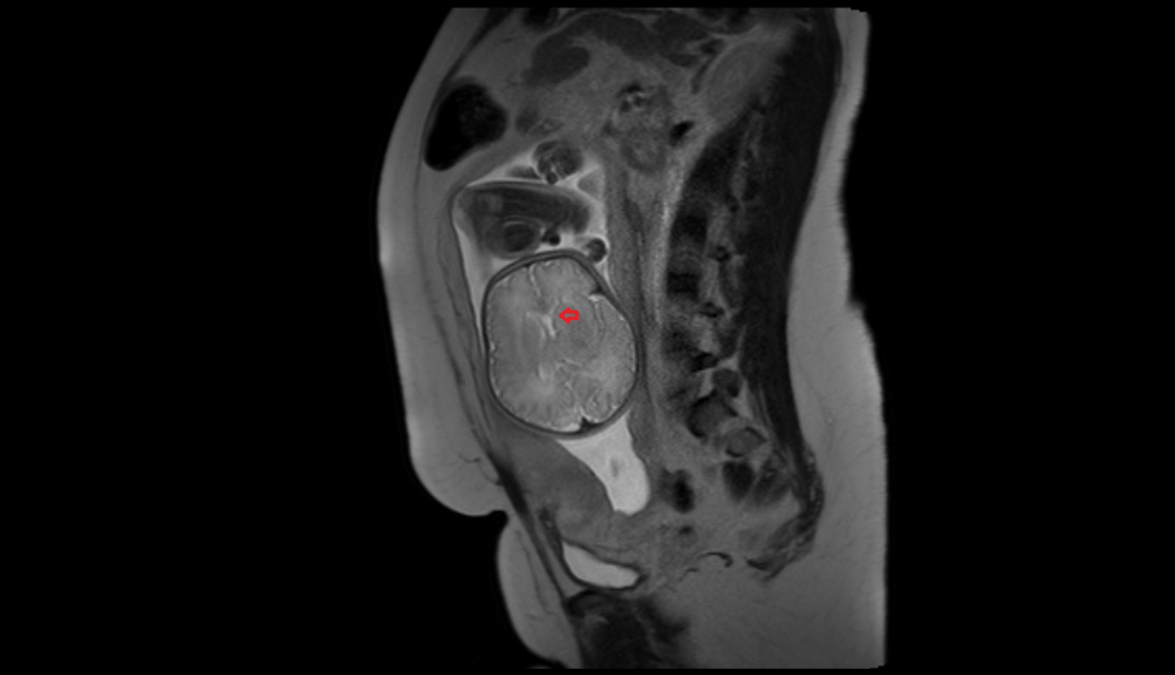 Fetal caudate nucleus MRI image