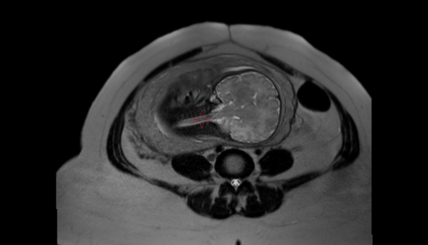 Fetal cervical spine  MRI coronal  anatomy image-img-00000-00000