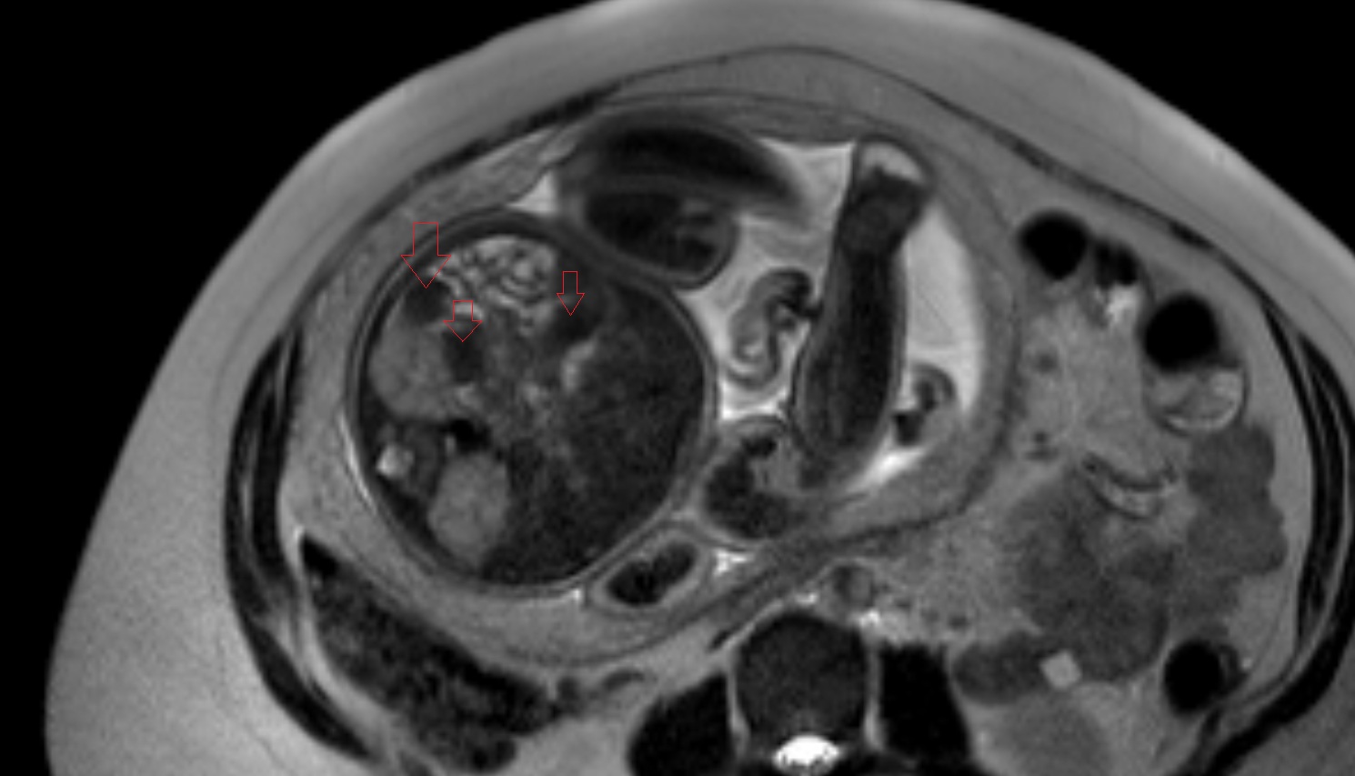 Fetal colon  MRI axial  anatomy image-img-00000-00000