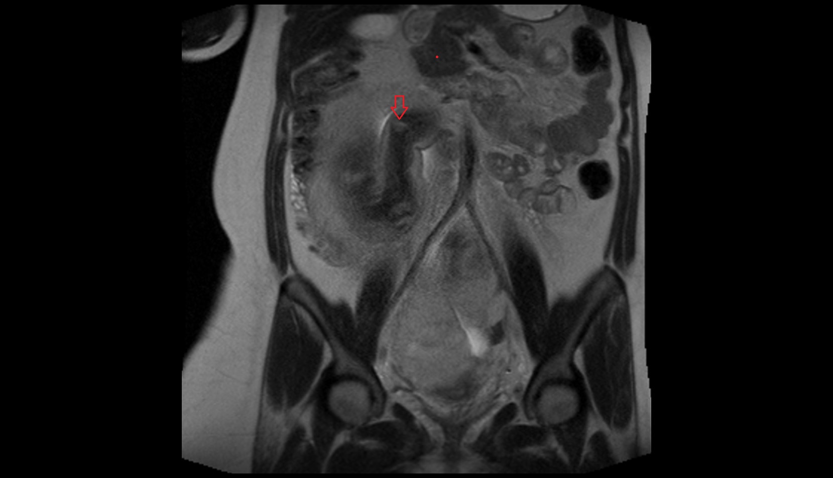 Fetal elbow mri image