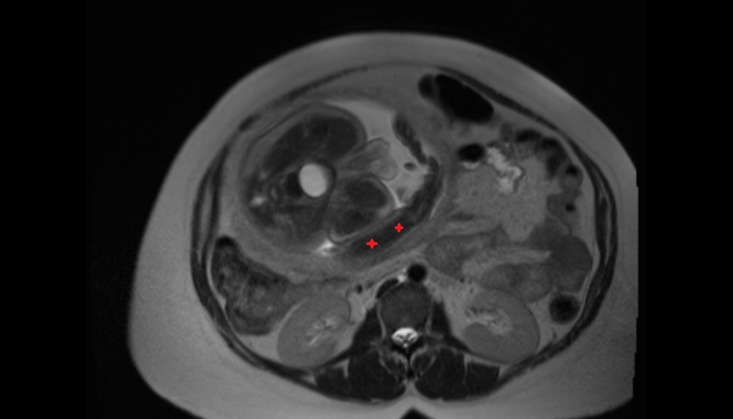Fetal forearm  MRI axial  anatomy image-img-00000-00000