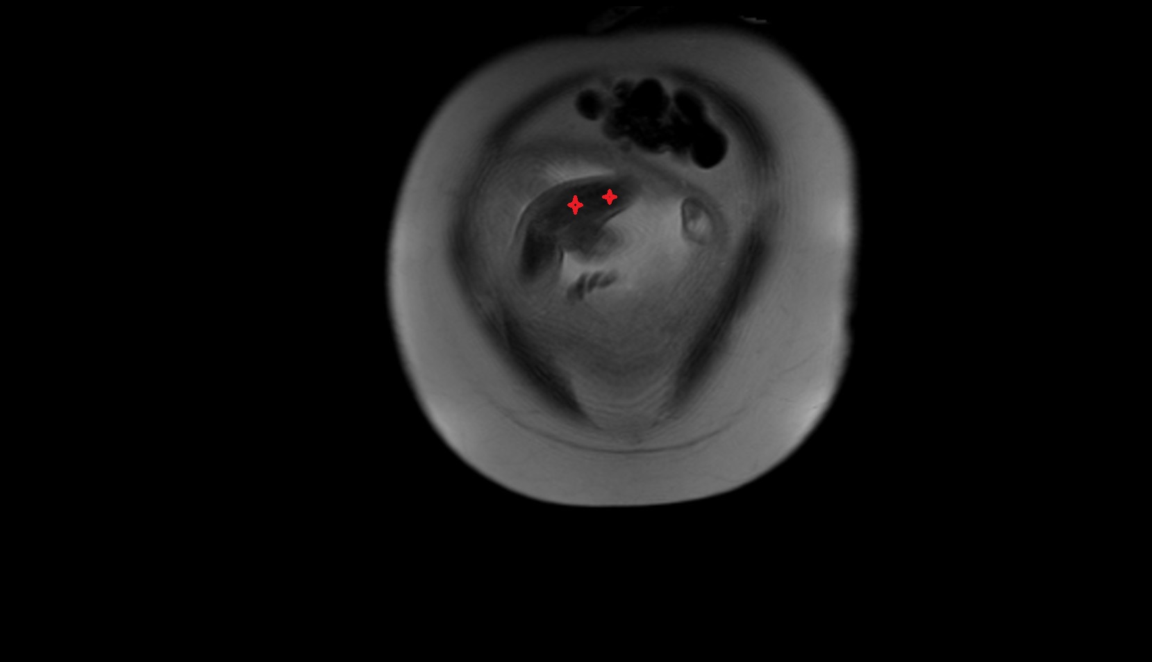 Fetal forearm mri sag image